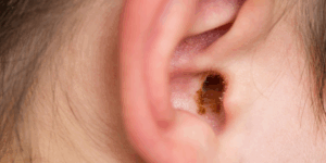 Ear Wax Removal in Nuneaton at Crowhill Pharmacy